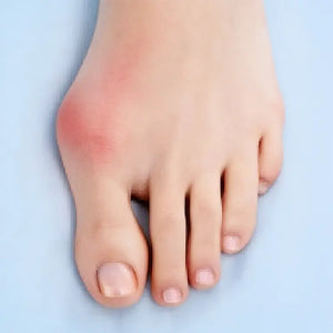 Bunion Relief